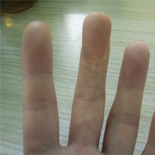 502胶水把手黏住了怎么办